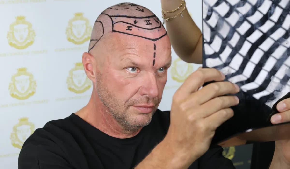 Hair Transplant London Techniques – FUE &amp; FUT Explained
