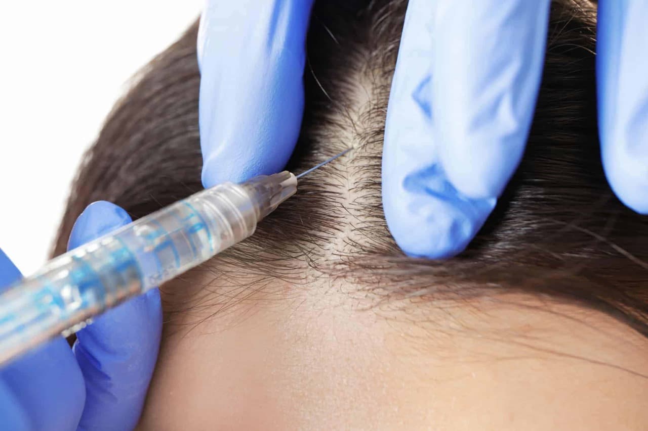 Hair Transplant London – Real Results, Real Confidence
