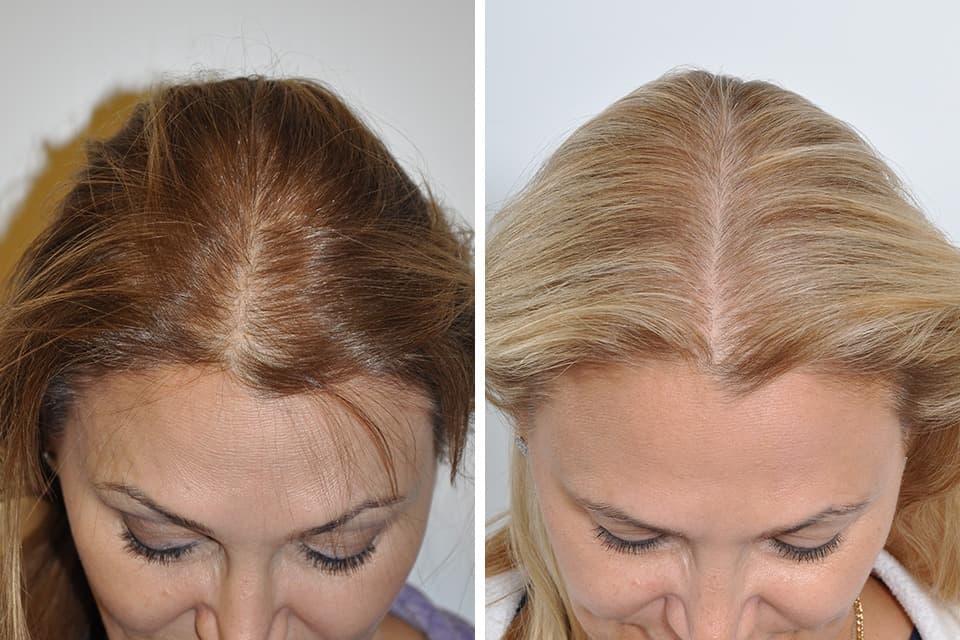 Hair Transplant Turkey: Compare Packages and Offers for 2025