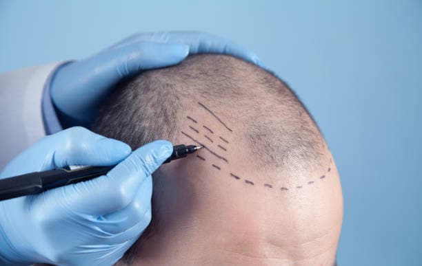 Hair Transplant Price Breakdown: What You Are Paying For