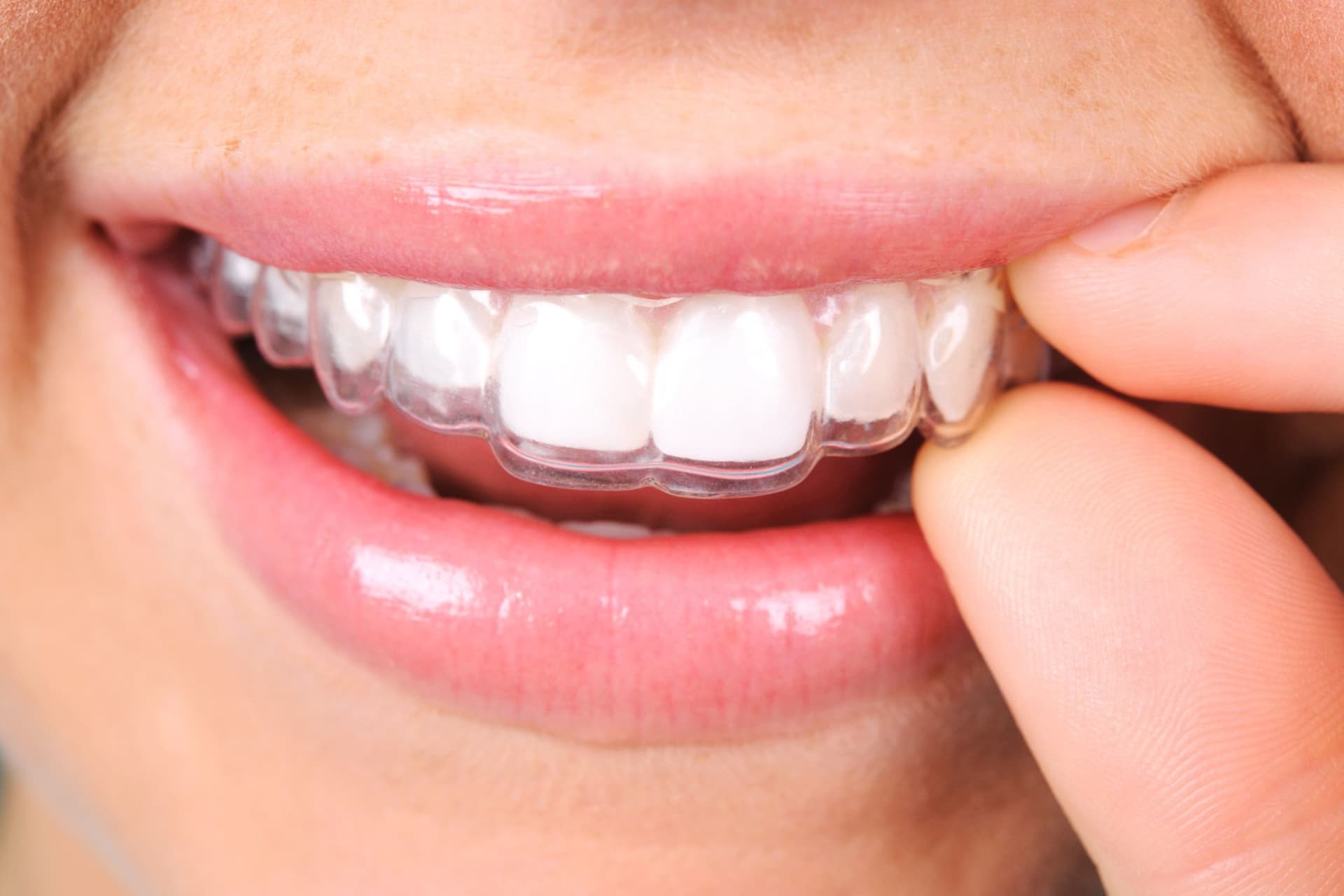 Everything You Need to Know About Ceramic Braces