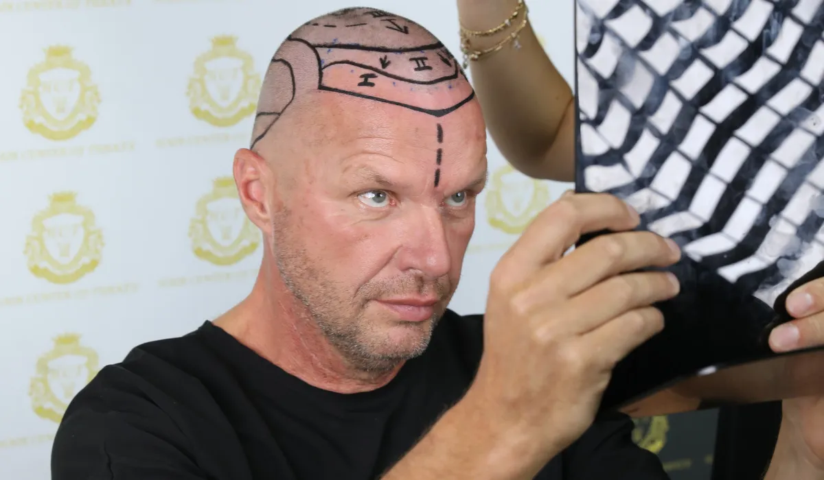 Hair Transplant London Techniques – FUE & FUT Explained